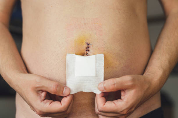 Best Hernia Repair Treatment In Lokhandwala, Andheri